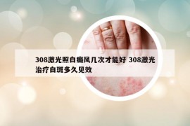 308激光照白癜風(fēng)幾次才能好 308激光治療白斑多久見效