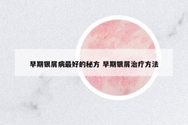 早期銀屑病最好的秘方 早期銀屑治療方法