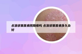 點滴狀銀屑病初期癢嗎 點滴狀銀屑病多久會好