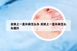 皮膚上一直長癬怎么辦 皮膚上一直長癬怎么辦圖片