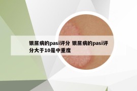 銀屑病的pasi評分 銀屑病的pasi評分大于10是中重度
