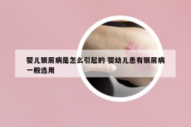 嬰兒銀屑病是怎么引起的 嬰幼兒患有銀屑病一般選用