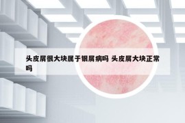 頭皮屑很大塊屬于銀屑病嗎 頭皮屑大塊正常嗎