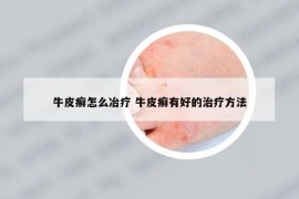 牛皮癬怎么冶療 牛皮癬有好的治療方法