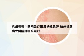 杭州哪哪個醫(yī)院治療銀屑病效果好 杭州銀屑病?？漆t(yī)院哪家最好