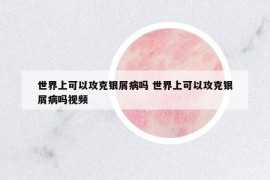 世界上可以攻克銀屑病嗎 世界上可以攻克銀屑病嗎視頻