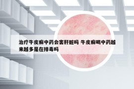 治療牛皮癬中藥會(huì)害肝臟嗎 牛皮癬喝中藥越來(lái)越多是在排毒嗎