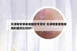 天津哪家銀屑病醫(yī)院專家好 天津哪里看銀屑病的醫(yī)院比較好?
