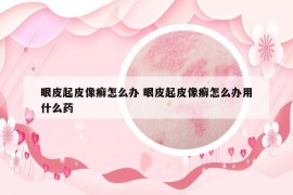 眼皮起皮像癬怎么辦 眼皮起皮像癬怎么辦用什么藥