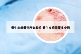 看牛皮癬看守所會(huì)收嗎 看牛皮癬需要多少錢