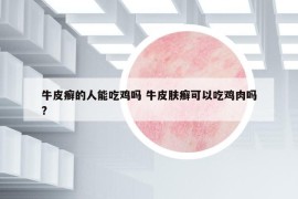牛皮癬的人能吃雞嗎 牛皮膚癬可以吃雞肉嗎?