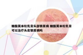糠酸莫米松乳膏頭部銀屑病 糠酸莫米松乳膏可以治療頭皮銀屑病嗎