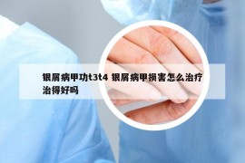 銀屑病甲功t3t4 銀屑病甲損害怎么治療治得好嗎
