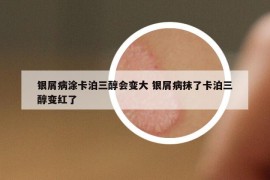 銀屑病涂卡泊三醇會變大 銀屑病抹了卡泊三醇變紅了