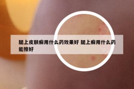 腿上皮膚癬用什么藥效果好 腿上癬用什么藥能擦好
