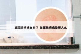 掌跖膿皰病自愈了 掌跖膿皰病能死人么
