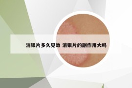 消銀片多久見效 消銀片的副作用大嗎