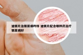 迪銀片治銀屑病咋樣 迪銀片配合哪種藥治療銀屑病好