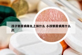 孩子銀屑病睪丸上抹什么 小孩銀屑病用什么藥