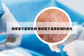 瘙癢是不是銀屑病 瘙癢是不是銀屑病的前兆