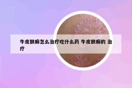 牛皮膚癬怎么治療吃什么藥 牛皮膚癬的 治療