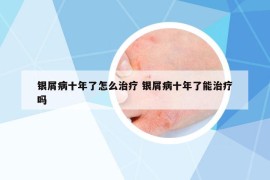 銀屑病十年了怎么治療 銀屑病十年了能治療嗎