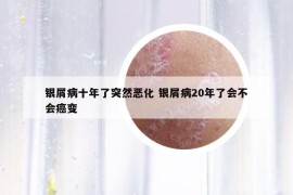 銀屑病十年了突然惡化 銀屑病20年了會不會癌變