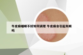 牛皮癬睡眠不好如何調(diào)理 牛皮癬會(huì)引起失眠嗎