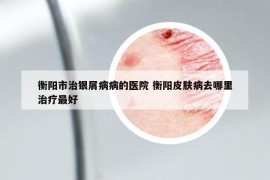 衡陽市治銀屑病病的醫(yī)院 衡陽皮膚病去哪里治療最好