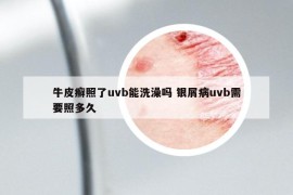 牛皮癬照了uvb能洗澡嗎 銀屑病uvb需要照多久