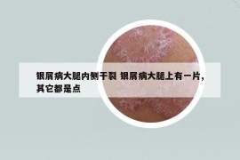 銀屑病大腿內(nèi)側(cè)干裂 銀屑病大腿上有一片,其它都是點