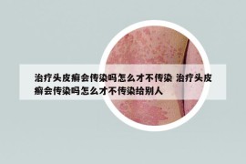 治療頭皮癬會(huì)傳染嗎怎么才不傳染 治療頭皮癬會(huì)傳染嗎怎么才不傳染給別人