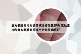 復(fù)方氨肽素片對銀屑病治療效果好嗎 氨肽素片和復(fù)方氨肽素片哪個治銀屑病更好