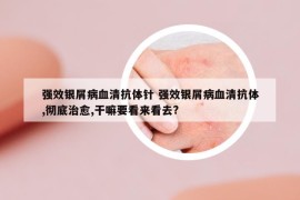 強效銀屑病血清抗體針 強效銀屑病血清抗體,徹底治愈,干嘛要看來看去?