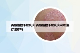 丙酸倍他米松乳膏 丙酸倍他米松乳膏可以治療濕疹嗎