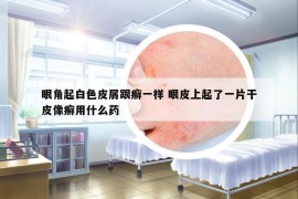 眼角起白色皮屑跟癬一樣 眼皮上起了一片干皮像癬用什么藥