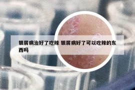 銀屑病治好了吃辣 銀屑病好了可以吃辣的東西嗎