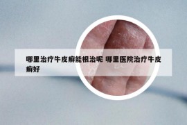 哪里治療牛皮癬能根治呢 哪里醫(yī)院治療牛皮癬好