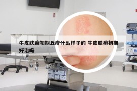 牛皮膚癬初期丘疹什么樣子的 牛皮膚癬初期好治嗎