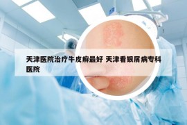 天津醫(yī)院治療牛皮癬最好 天津看銀屑病??漆t(yī)院