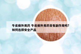 牛皮癬外用藥 牛皮癬外用藥膏有副作用嗎?如何選擇安全產(chǎn)品