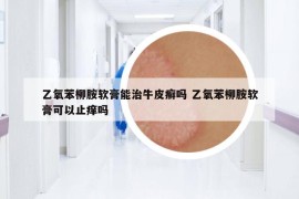 乙氧苯柳胺軟膏能治牛皮癬嗎 乙氧苯柳胺軟膏可以止癢嗎