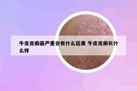 牛皮皮癬最嚴(yán)重會(huì)有什么后果 牛皮皮癬長(zhǎng)什么樣
