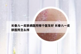 長(zhǎng)春八一皮膚病醫(yī)院哪個(gè)醫(yī)生好 長(zhǎng)春八一皮膚醫(yī)院怎么樣