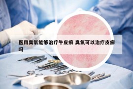 醫(yī)用臭氧能夠治療牛皮癬 臭氧可以治療皮癬嗎