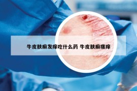 牛皮膚癬發(fā)癢吃什么藥 牛皮膚癬瘙癢