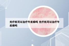 光療機(jī)可以治療牛皮癬嗎 光療機(jī)可以治療牛皮癬嗎