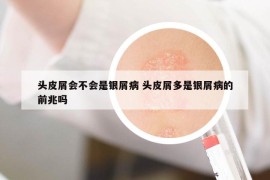 頭皮屑會不會是銀屑病 頭皮屑多是銀屑病的前兆嗎
