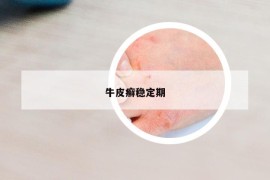 牛皮癬穩(wěn)定期