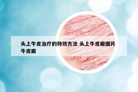 頭上牛皮治療的特效方法 頭上牛皮廨圖片 牛皮廨